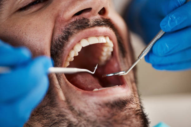Best Emergency Dentist for Knocked-Out Tooth in Emerald Bay, TX